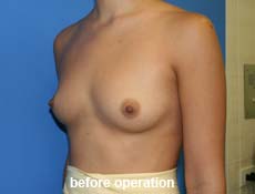 plastic-surgery-breast-augmentation 